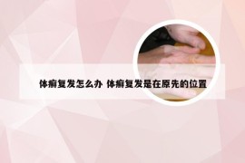 体癣复发怎么办 体癣复发是在原先的位置