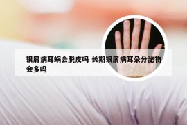 银屑病耳蜗会脱皮吗 长期银屑病耳朵分泌物会多吗