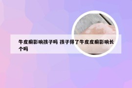 牛皮癣影响孩子吗 孩子得了牛皮皮癣影响长个吗