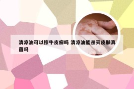 清凉油可以擦牛皮癣吗 清凉油能杀灭皮肤真菌吗