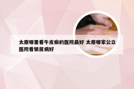 太原哪里看牛皮癣的医院最好 太原哪家公立医院看银屑病好