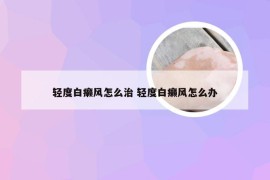 轻度白癞风怎么治 轻度白癞风怎么办