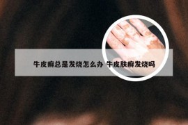 牛皮癣总是发烧怎么办 牛皮肤癣发烧吗