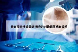 善存能治疗银屑病 善存片对治银屑病有效吗