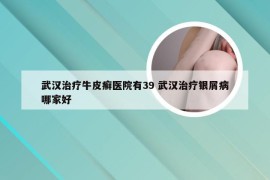 武汉治疗牛皮癣医院有39 武汉治疗银屑病哪家好