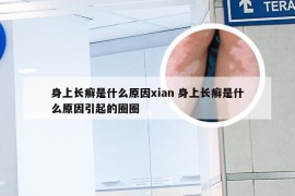 身上长癣是什么原因xian 身上长癣是什么原因引起的圈圈