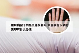 银屑病留下的黑斑能恢复吗 银屑病留下来的黑印有什么办法