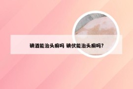 碘酒能治头癣吗 碘伏能治头癣吗?