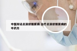 中医辩证点滴状银屑病 治疗点滴状银屑病的中药方