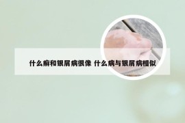 什么癣和银屑病很像 什么病与银屑病相似