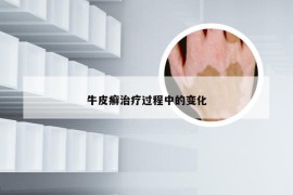 牛皮癣治疗过程中的变化