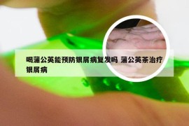 喝蒲公英能预防银屑病复发吗 蒲公英茶治疗银屑病