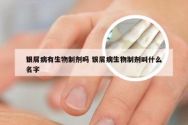 银屑病有生物制剂吗 银屑病生物制剂叫什么名字