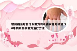 银屑病治疗有什么偏方有名西安北方精湛 30年的银屑病偏方治疗方法