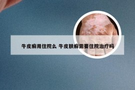 牛皮癣用住院么 牛皮肤癣需要住院治疗吗