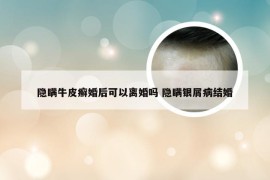 隐瞒牛皮癣婚后可以离婚吗 隐瞒银屑病结婚