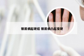 银屑病起硬结 银屑病凸起变硬