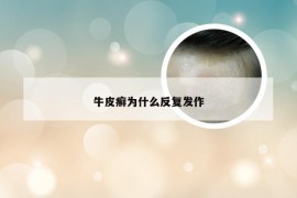 牛皮癣为什么反复发作