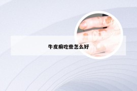 牛皮癣吃些怎么好