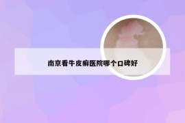 南京看牛皮癣医院哪个口碑好