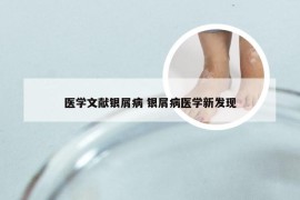 医学文献银屑病 银屑病医学新发现