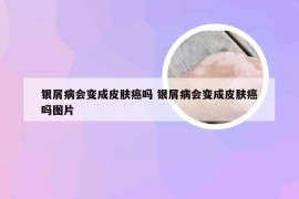 银屑病会变成皮肤癌吗 银屑病会变成皮肤癌吗图片