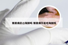 银屑病忌口海鲜吗 银屑病不能吃海鲜吗