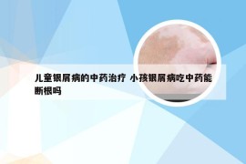 儿童银屑病的中药治疗 小孩银屑病吃中药能断根吗