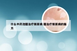 什么中药泡醋治疗银屑病 醋治疗银屑病的偏方