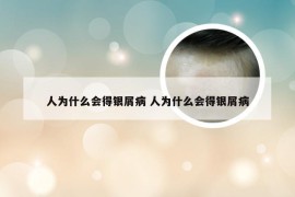 人为什么会得银屑病 人为什么会得银屑病