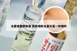 毛囊堵塞银屑病 银屑病和毛囊炎是一种病吗