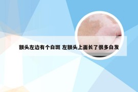 额头左边有个白斑 左额头上面长了很多白发