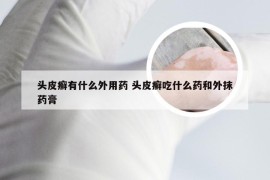 头皮癣有什么外用药 头皮癣吃什么药和外抹药膏