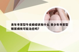 青年寻常型牛皮癣症状有什么 青少年寻常型银屑病有可能治愈吗?