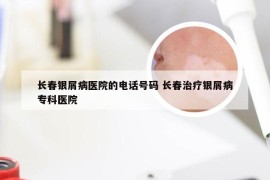 长春银屑病医院的电话号码 长春治疗银屑病专科医院