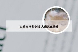 人癣治疗多少钱 人癣怎么治疗