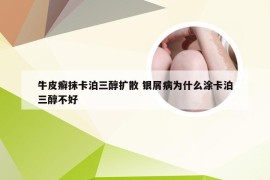 牛皮癣抹卡泊三醇扩散 银屑病为什么涂卡泊三醇不好