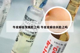 牛皮癣会发展脸上吗 牛皮皮癣会长脸上吗