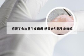 感冒了会加重牛皮癣吗 感冒会引起牛皮鲜吗