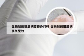 生物制剂银屑病要终身打吗 生物制剂银屑病多久见效