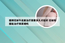 醋跟花椒牛皮廨治疗需要多久才能好 花椒和醋能治疗银屑病吗