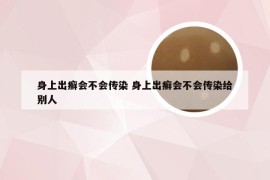 身上出癣会不会传染 身上出癣会不会传染给别人