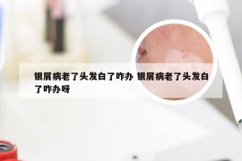 银屑病老了头发白了咋办 银屑病老了头发白了咋办呀