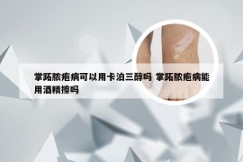 掌跖脓疱病可以用卡泊三醇吗 掌跖脓疱病能用酒精擦吗