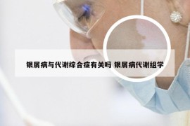 银屑病与代谢综合症有关吗 银屑病代谢组学