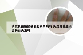 头皮真菌感染会引起银屑病吗 头皮真菌感染会长白头发吗