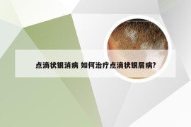 点滴状银消病 如何治疗点滴状银屑病?