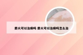 麝火可以治癣吗 麝火可以治癣吗怎么治