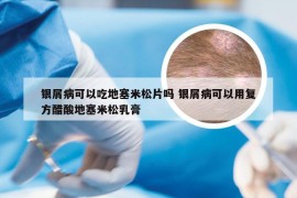 银屑病可以吃地塞米松片吗 银屑病可以用复方醋酸地塞米松乳膏