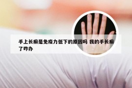 手上长癣是免疫力低下的原因吗 我的手长癣了咋办